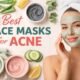 Best Face Masks for Acne
