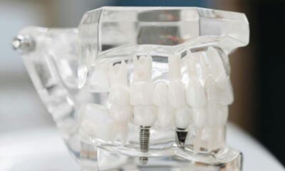 Dental Implants