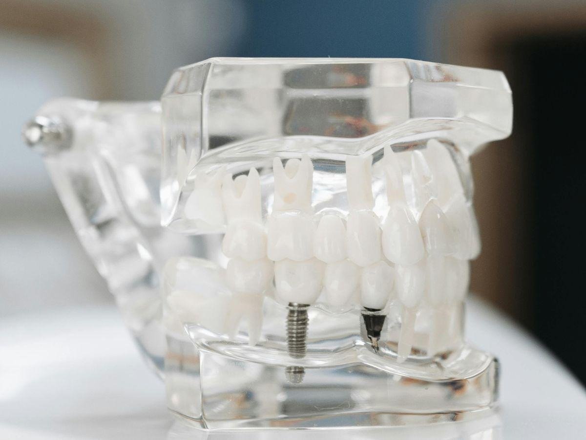 Dental Implants